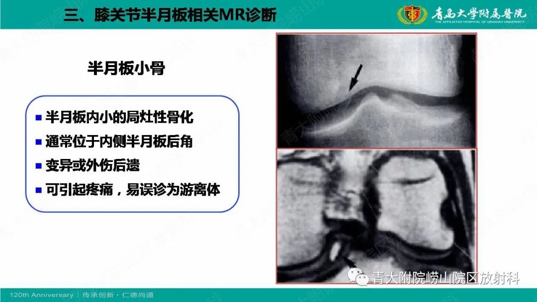 影像PPT - 【PPT】膝关节半月板及常见韧带损伤的磁共振诊断-22
