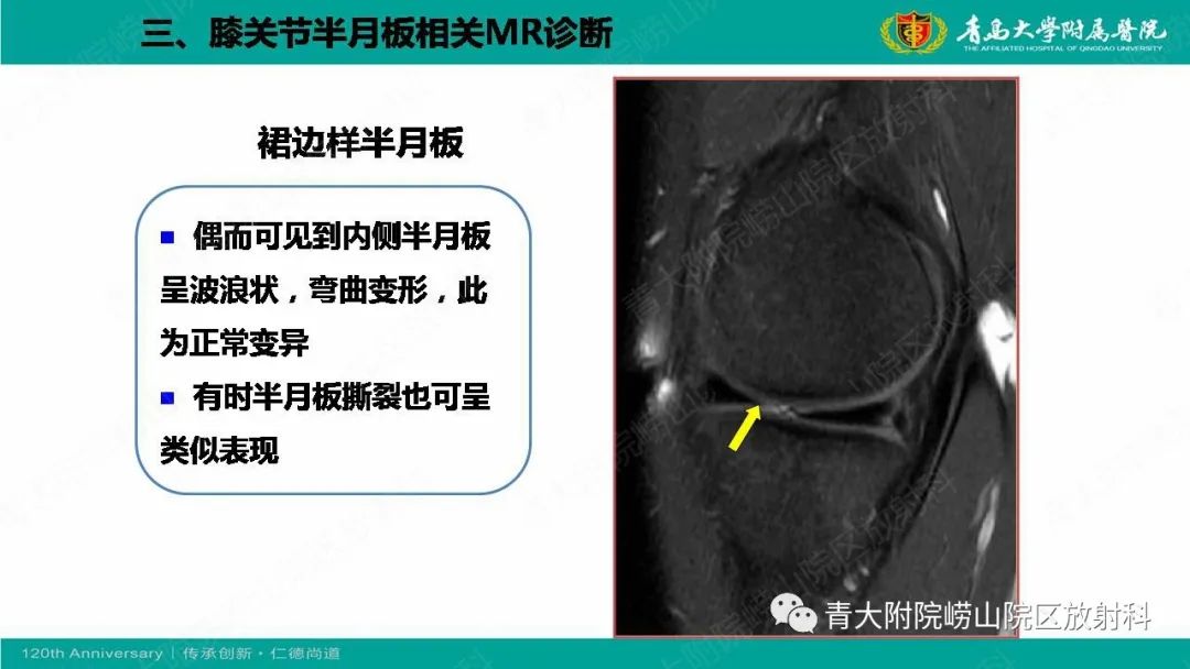 影像PPT - 【PPT】膝关节半月板及常见韧带损伤的磁共振诊断-21