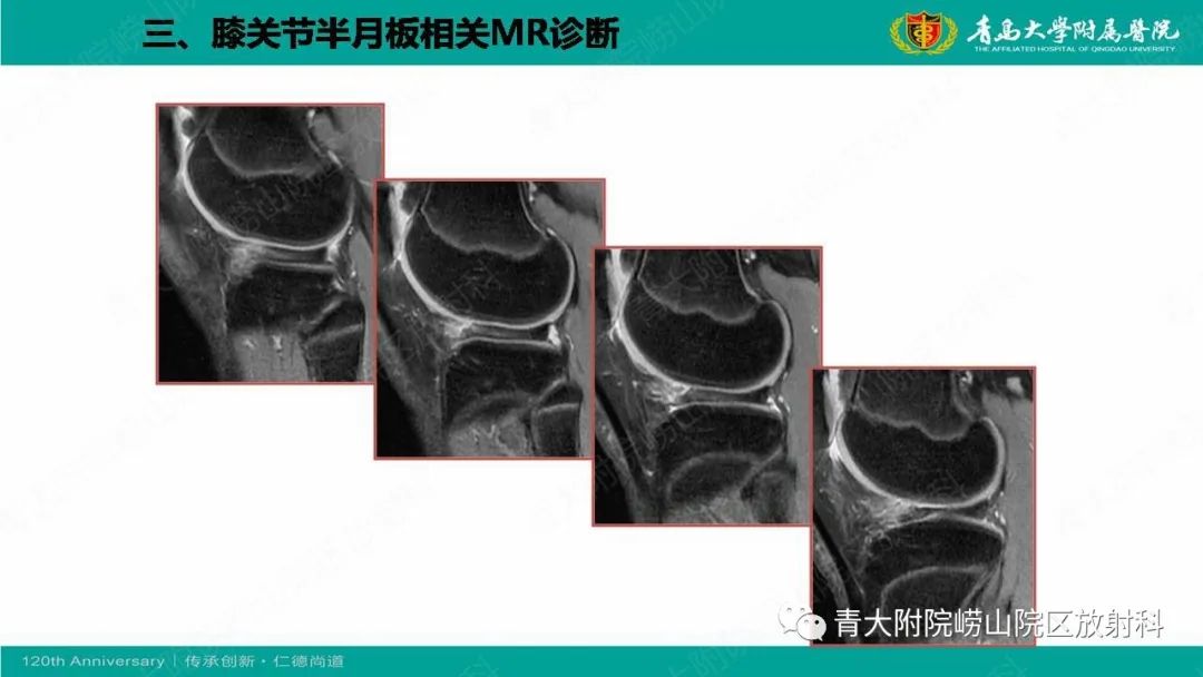 影像PPT - 【PPT】膝关节半月板及常见韧带损伤的磁共振诊断-20