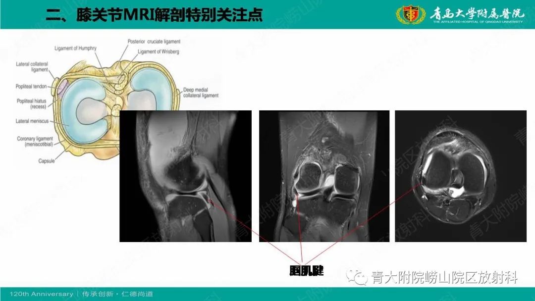 影像PPT - 【PPT】膝关节半月板及常见韧带损伤的磁共振诊断-9