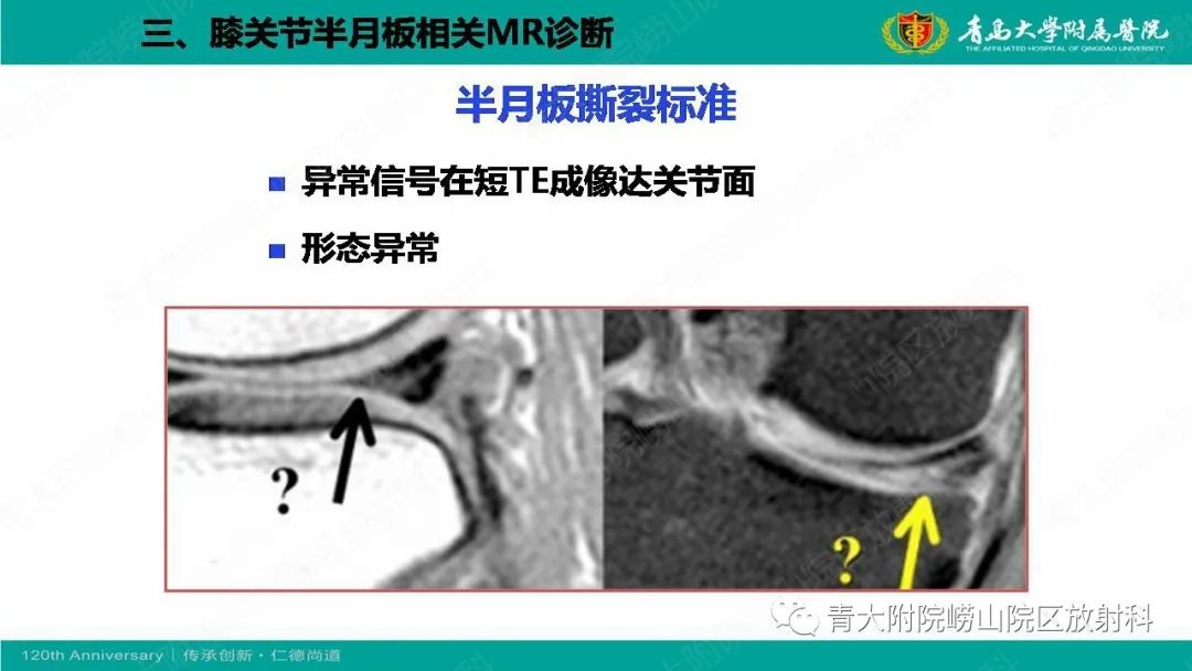 影像PPT - 【PPT】膝关节半月板及常见韧带损伤的磁共振诊断-26