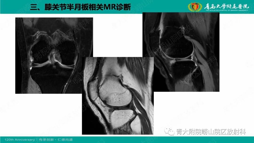 影像PPT - 【PPT】膝关节半月板及常见韧带损伤的磁共振诊断-30