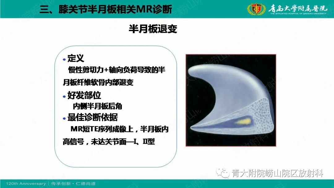 影像PPT - 【PPT】膝关节半月板及常见韧带损伤的磁共振诊断-29