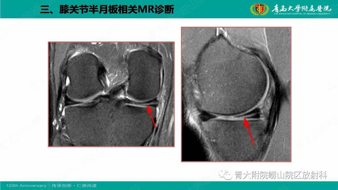 影像PPT - 【PPT】膝关节半月板及常见韧带损伤的磁共振诊断-32