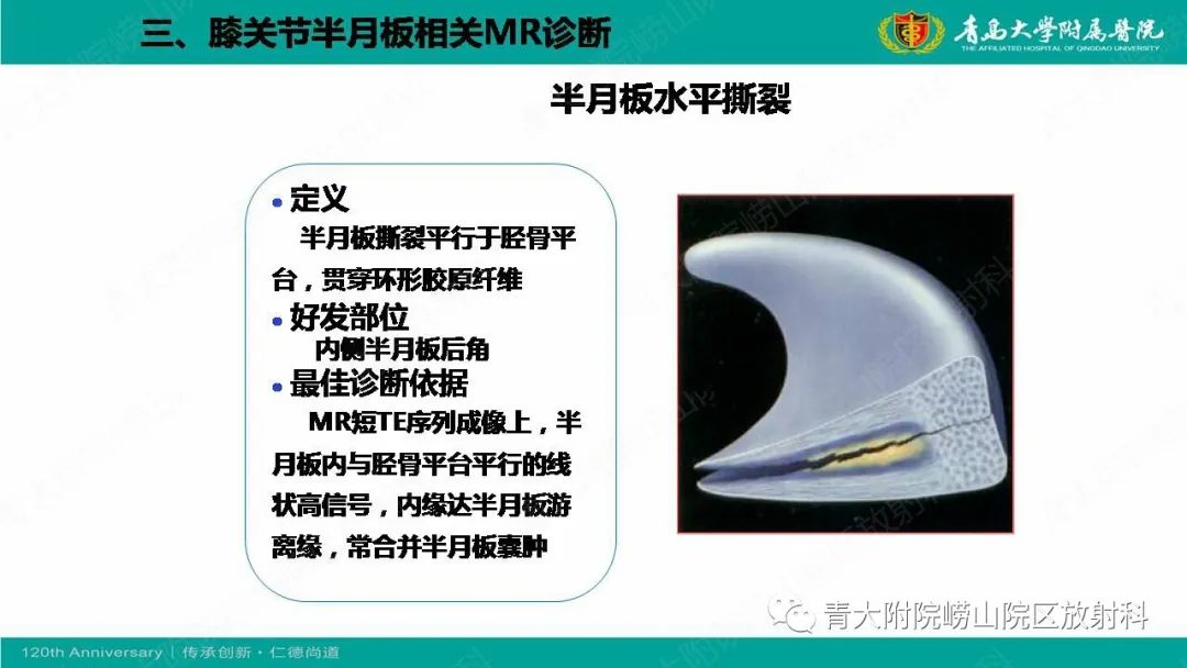 影像PPT - 【PPT】膝关节半月板及常见韧带损伤的磁共振诊断-31