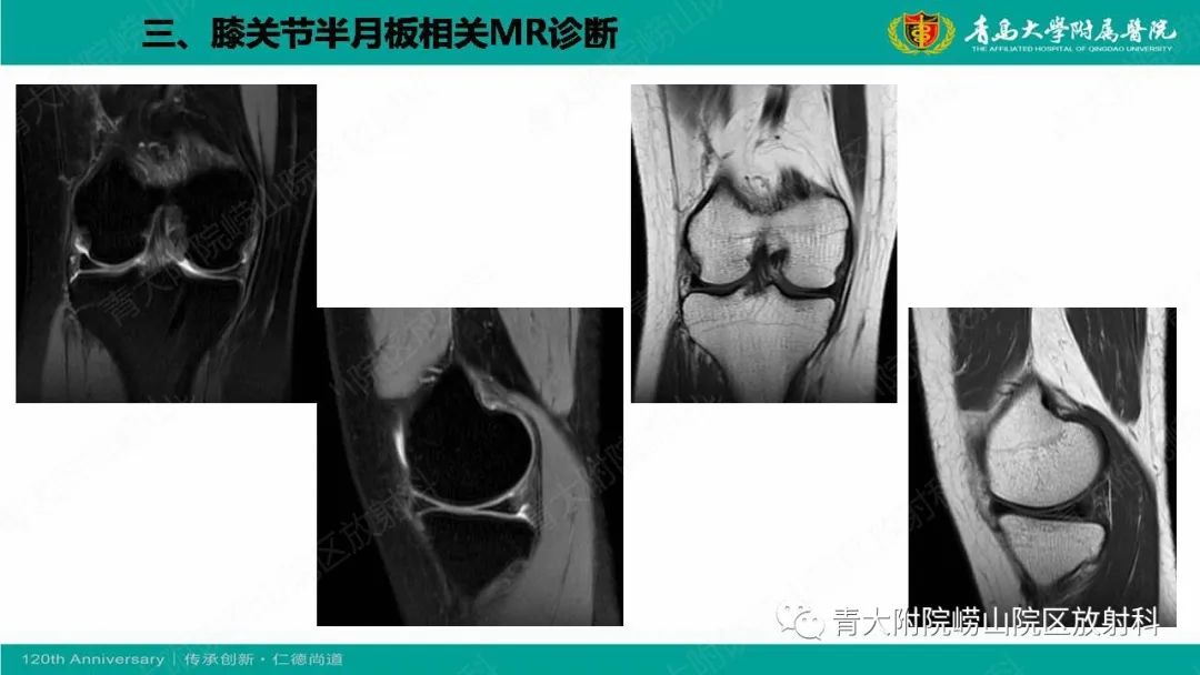 影像PPT - 【PPT】膝关节半月板及常见韧带损伤的磁共振诊断-33