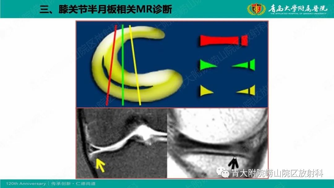 影像PPT - 【PPT】膝关节半月板及常见韧带损伤的磁共振诊断-35