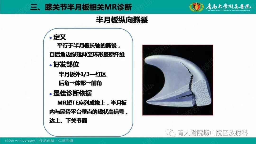 影像PPT - 【PPT】膝关节半月板及常见韧带损伤的磁共振诊断-34