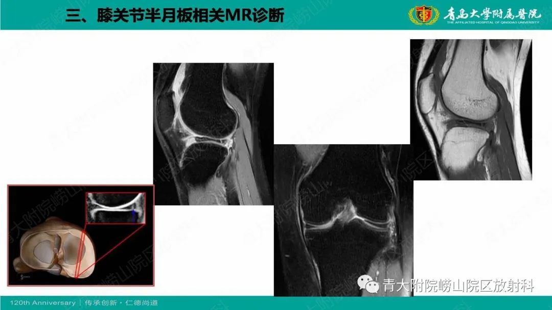 影像PPT - 【PPT】膝关节半月板及常见韧带损伤的磁共振诊断-36