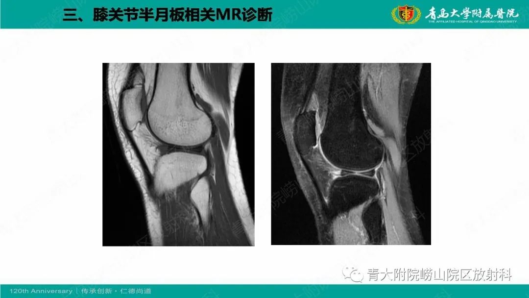 影像PPT - 【PPT】膝关节半月板及常见韧带损伤的磁共振诊断-39