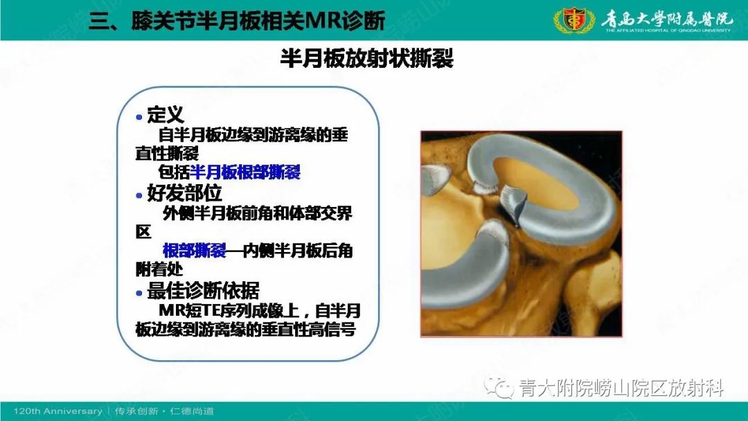 影像PPT - 【PPT】膝关节半月板及常见韧带损伤的磁共振诊断-37