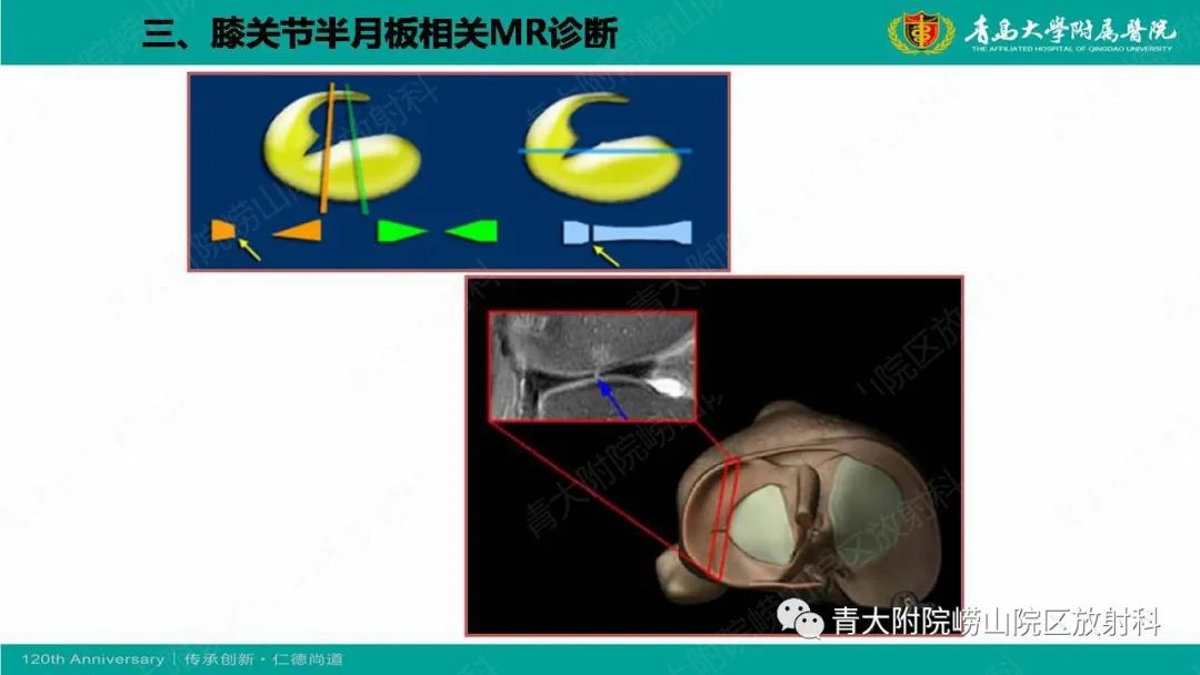 影像PPT - 【PPT】膝关节半月板及常见韧带损伤的磁共振诊断-38