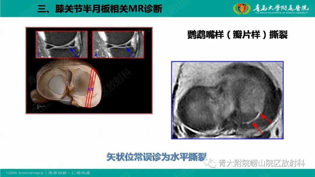 影像PPT - 【PPT】膝关节半月板及常见韧带损伤的磁共振诊断-42