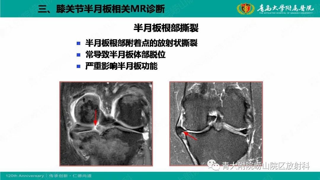 影像PPT - 【PPT】膝关节半月板及常见韧带损伤的磁共振诊断-40