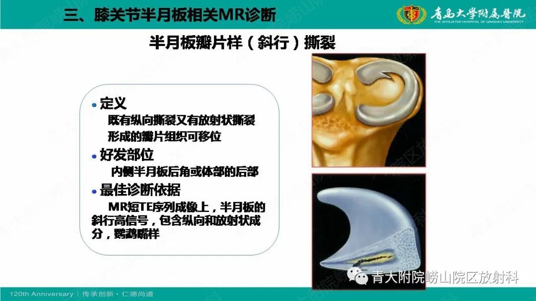 影像PPT - 【PPT】膝关节半月板及常见韧带损伤的磁共振诊断-41