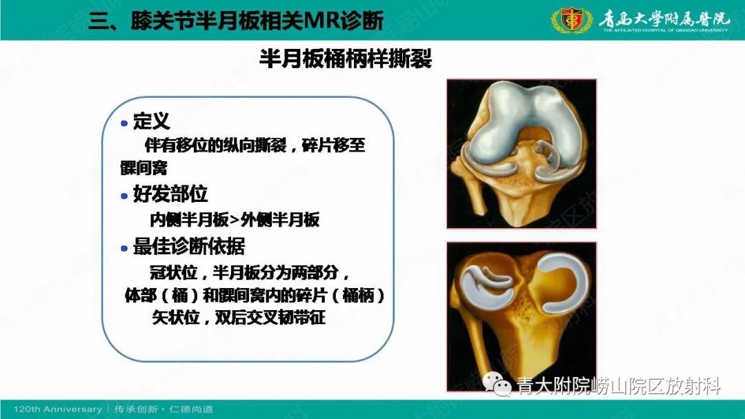 影像PPT - 【PPT】膝关节半月板及常见韧带损伤的磁共振诊断-43