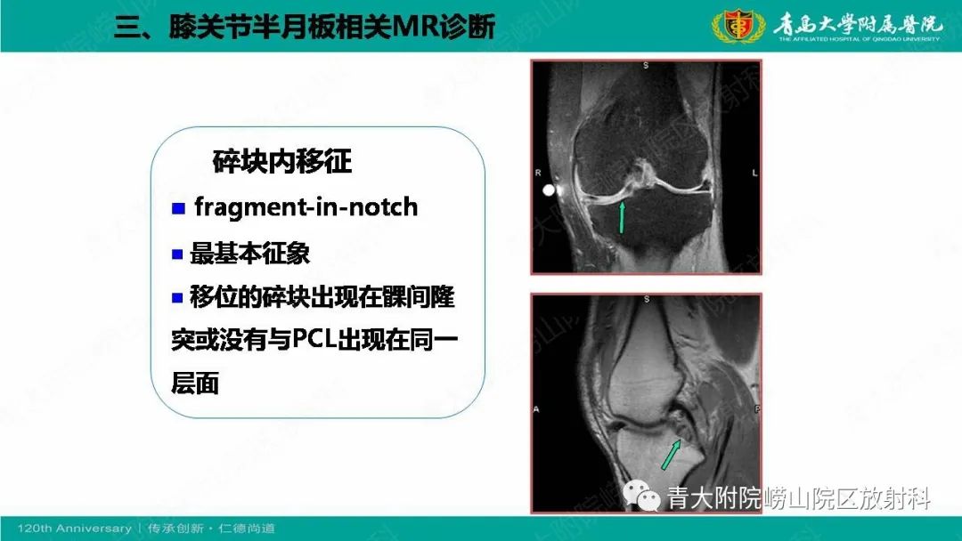 影像PPT - 【PPT】膝关节半月板及常见韧带损伤的磁共振诊断-45