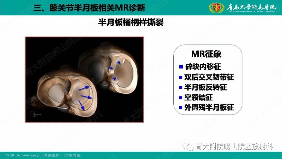 影像PPT - 【PPT】膝关节半月板及常见韧带损伤的磁共振诊断-44