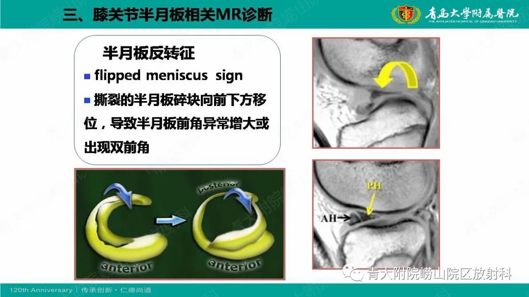 影像PPT - 【PPT】膝关节半月板及常见韧带损伤的磁共振诊断-47