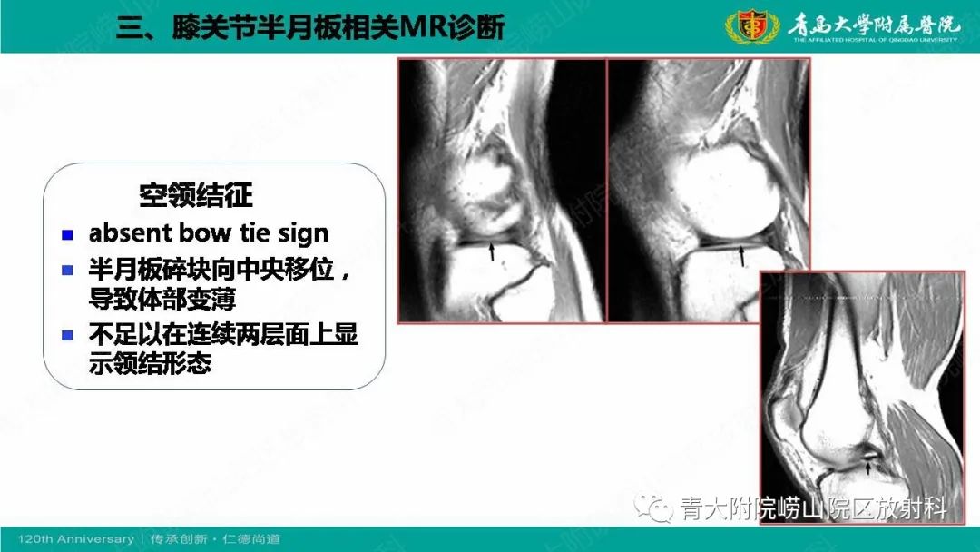影像PPT - 【PPT】膝关节半月板及常见韧带损伤的磁共振诊断-48
