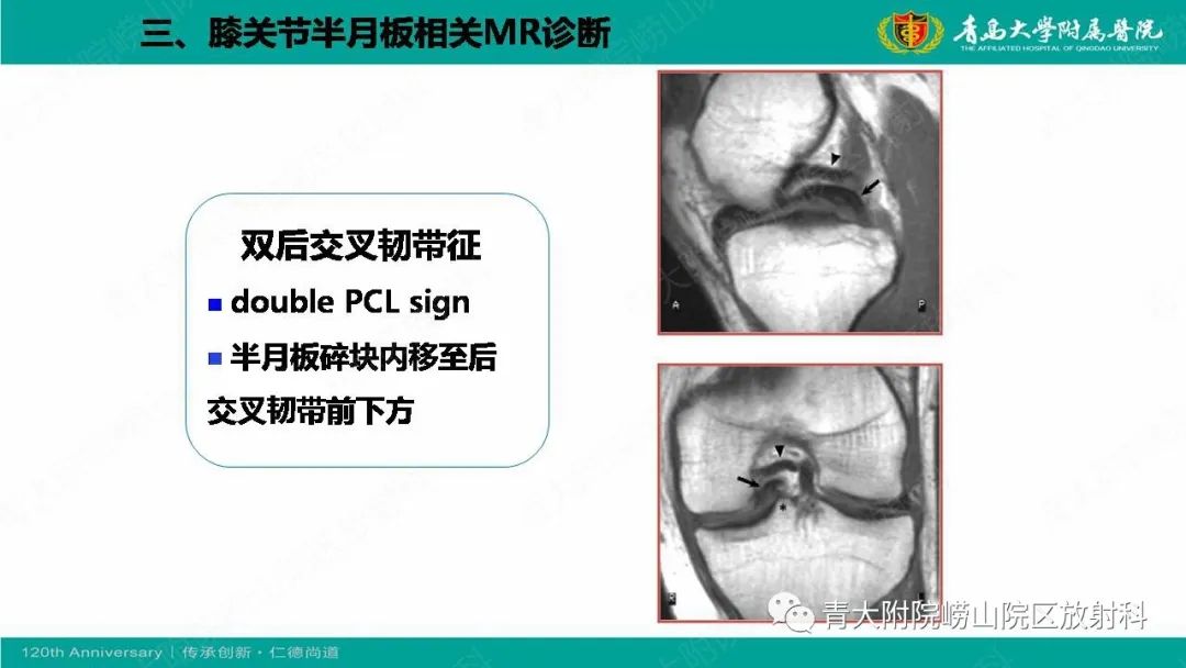影像PPT - 【PPT】膝关节半月板及常见韧带损伤的磁共振诊断-46