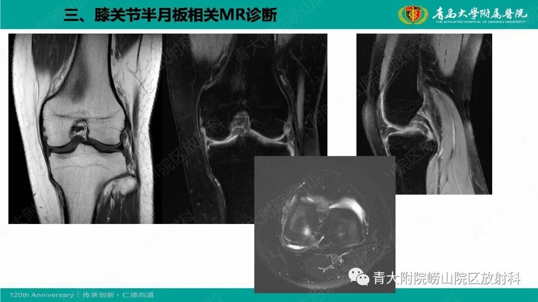 影像PPT - 【PPT】膝关节半月板及常见韧带损伤的磁共振诊断-49