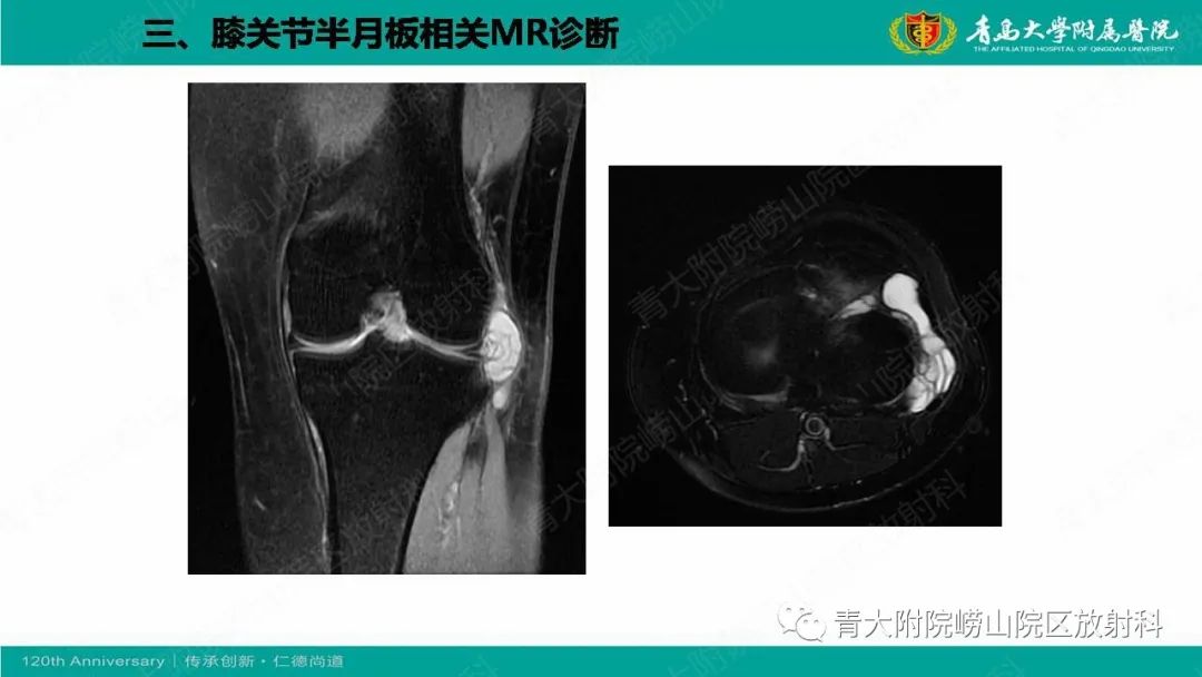 影像PPT - 【PPT】膝关节半月板及常见韧带损伤的磁共振诊断-52