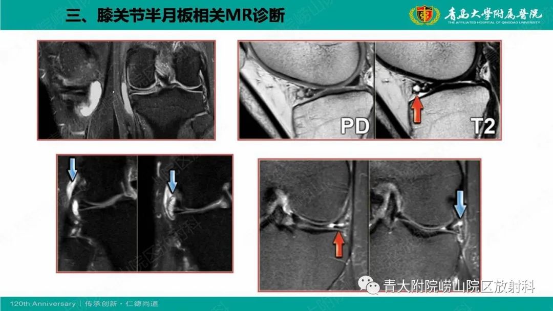 影像PPT - 【PPT】膝关节半月板及常见韧带损伤的磁共振诊断-51