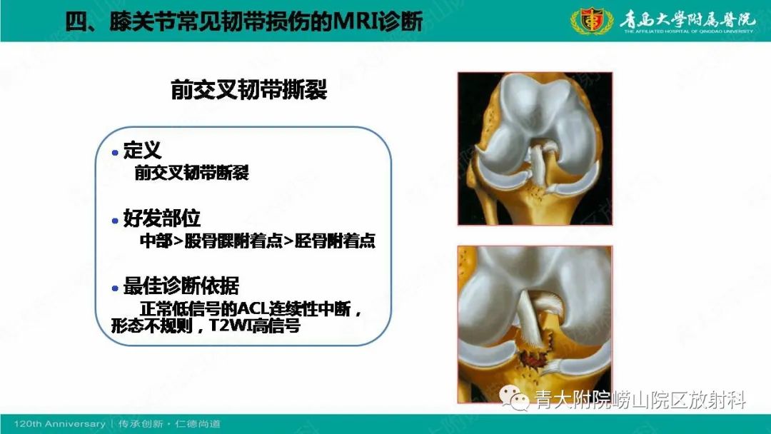 影像PPT - 【PPT】膝关节半月板及常见韧带损伤的磁共振诊断-54