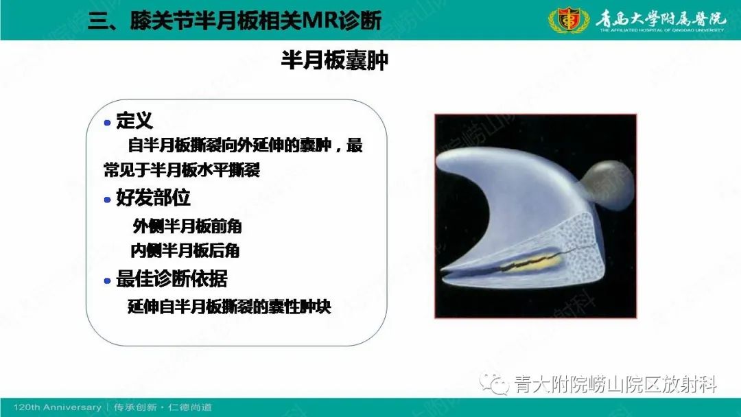 影像PPT - 【PPT】膝关节半月板及常见韧带损伤的磁共振诊断-50