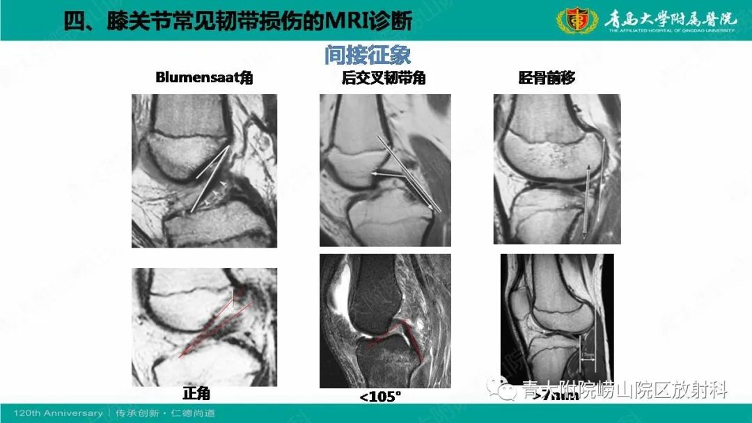 影像PPT - 【PPT】膝关节半月板及常见韧带损伤的磁共振诊断-56
