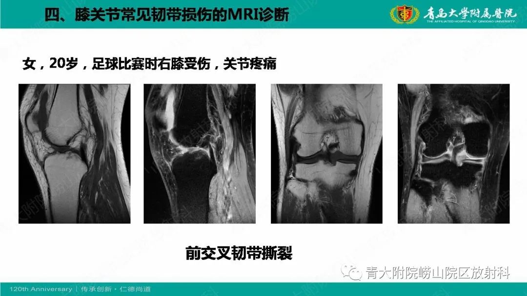 影像PPT - 【PPT】膝关节半月板及常见韧带损伤的磁共振诊断-57