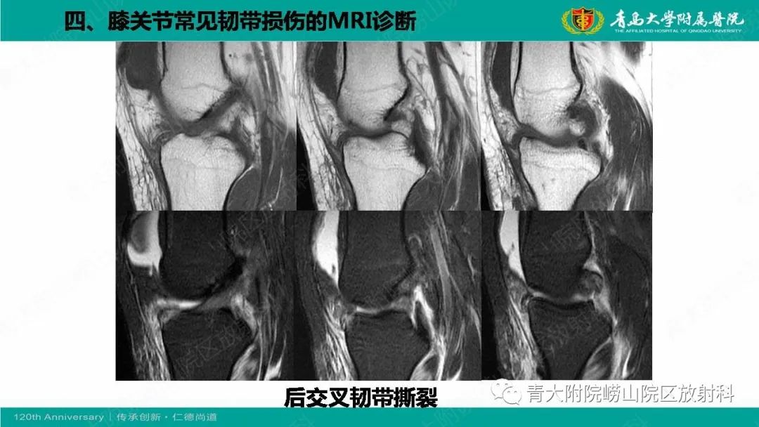 影像PPT - 【PPT】膝关节半月板及常见韧带损伤的磁共振诊断-60