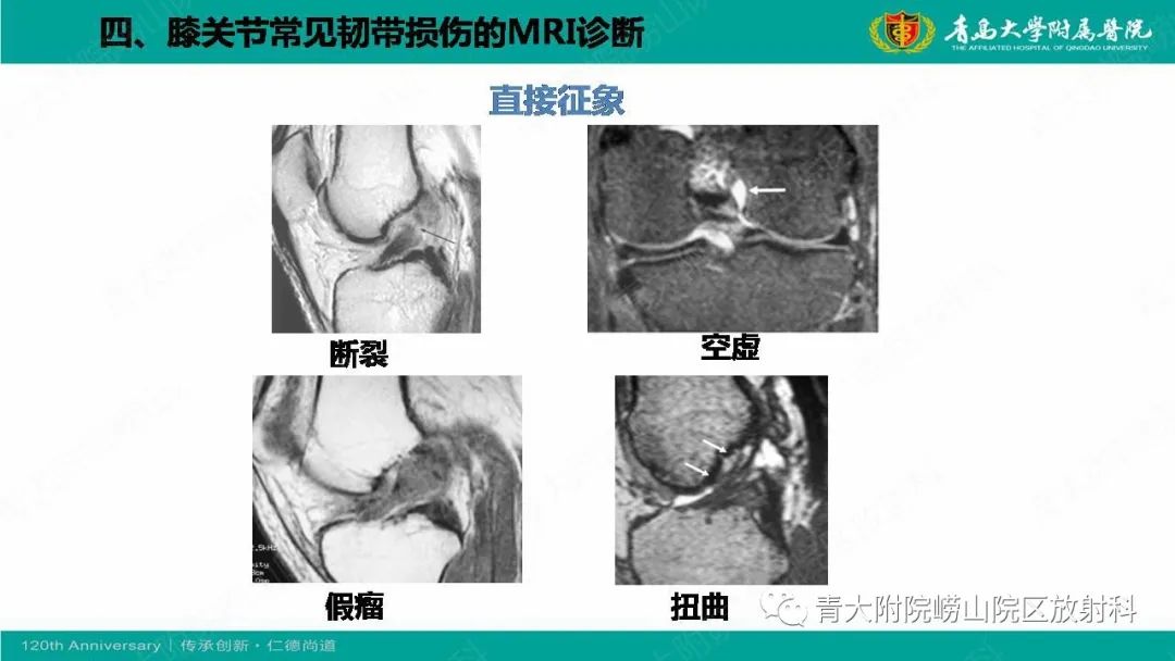影像PPT - 【PPT】膝关节半月板及常见韧带损伤的磁共振诊断-55