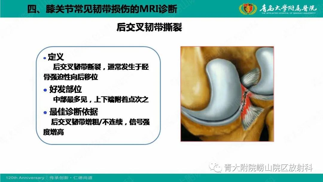 影像PPT - 【PPT】膝关节半月板及常见韧带损伤的磁共振诊断-59