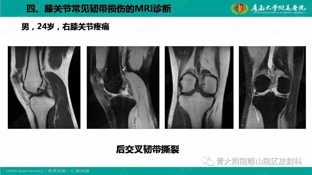 影像PPT - 【PPT】膝关节半月板及常见韧带损伤的磁共振诊断-61