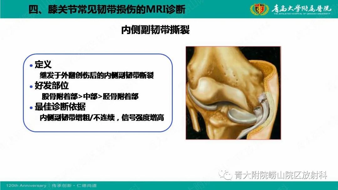 影像PPT - 【PPT】膝关节半月板及常见韧带损伤的磁共振诊断-62