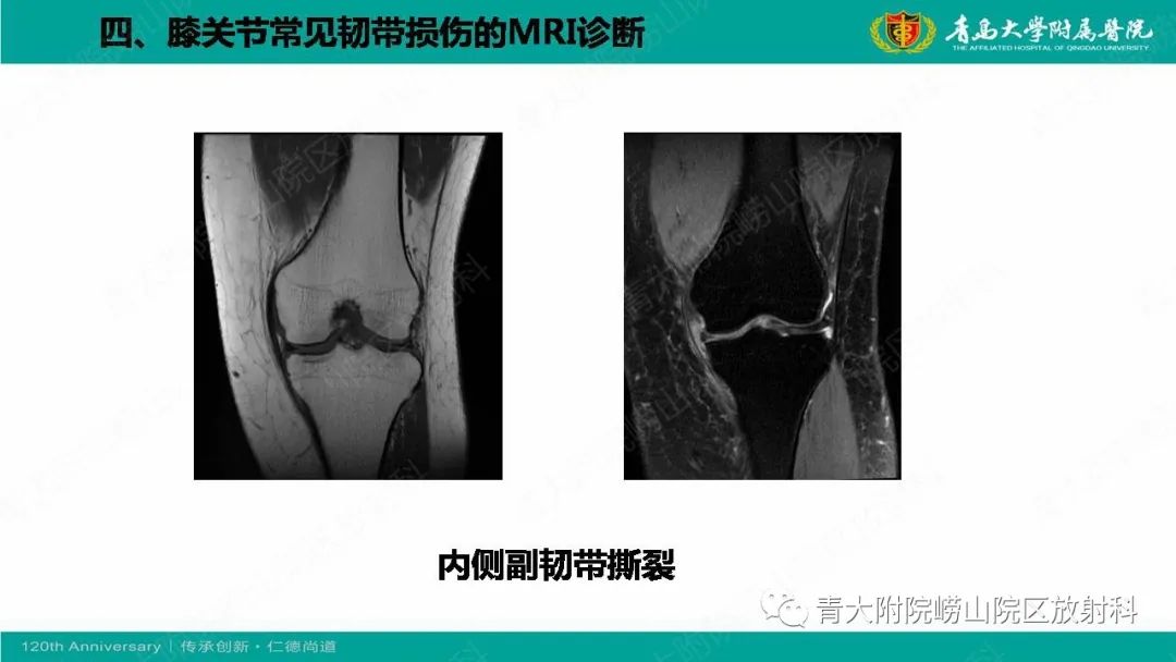 影像PPT - 【PPT】膝关节半月板及常见韧带损伤的磁共振诊断-64