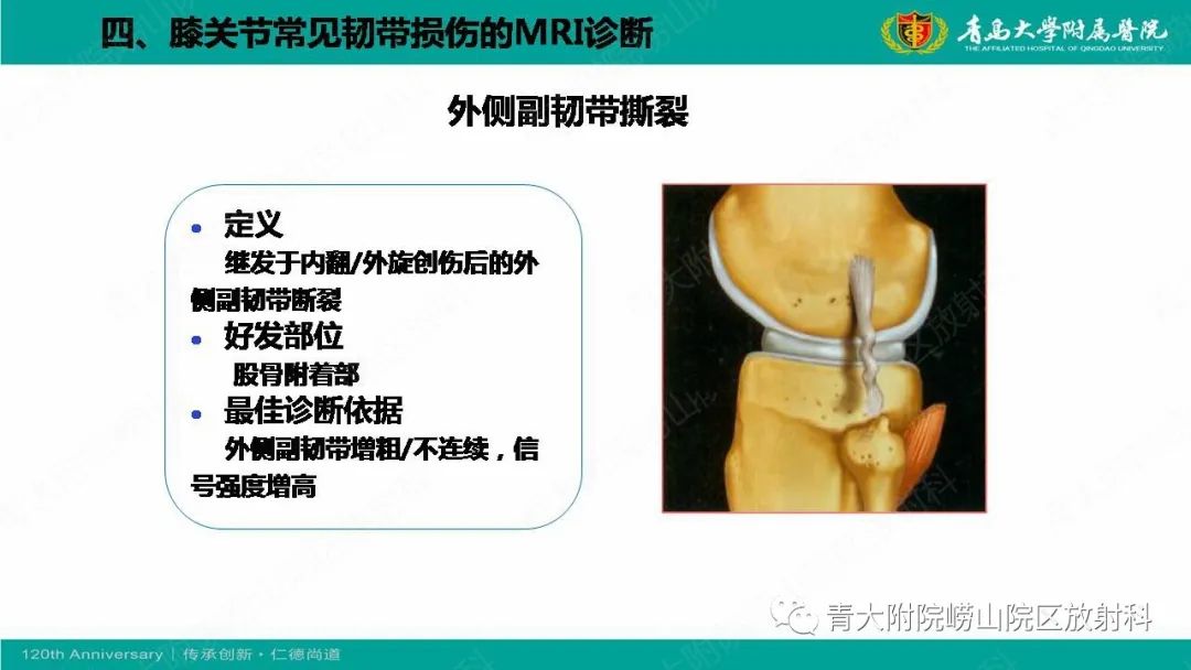 影像PPT - 【PPT】膝关节半月板及常见韧带损伤的磁共振诊断-65