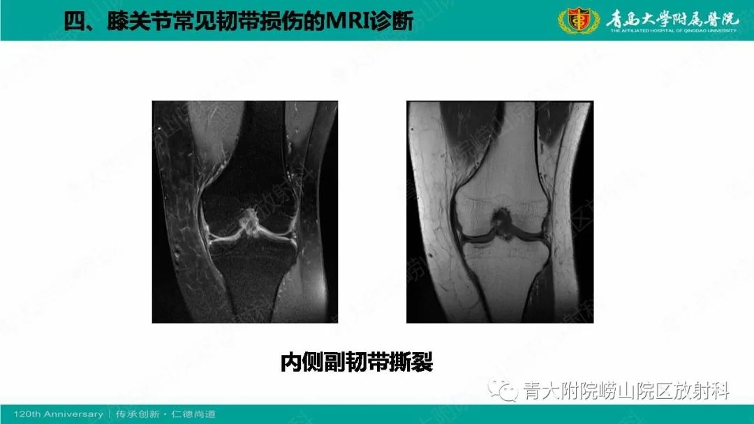 影像PPT - 【PPT】膝关节半月板及常见韧带损伤的磁共振诊断-63