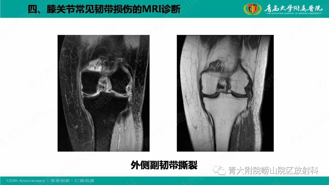 影像PPT - 【PPT】膝关节半月板及常见韧带损伤的磁共振诊断-66