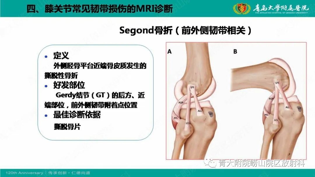影像PPT - 【PPT】膝关节半月板及常见韧带损伤的磁共振诊断-67