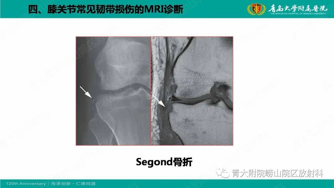 影像PPT - 【PPT】膝关节半月板及常见韧带损伤的磁共振诊断-68