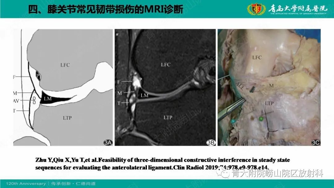 影像PPT - 【PPT】膝关节半月板及常见韧带损伤的磁共振诊断-69