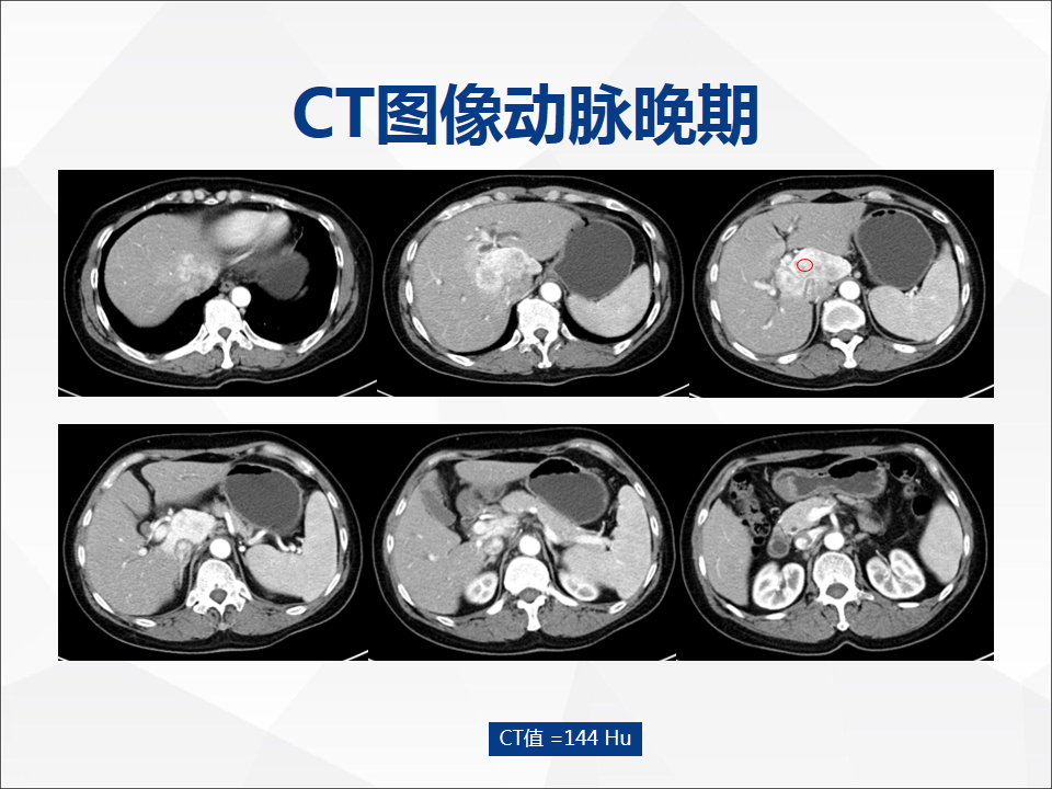 影像PPT - 【病例】肝脏胆管细胞癌1例CT及MR影像-4