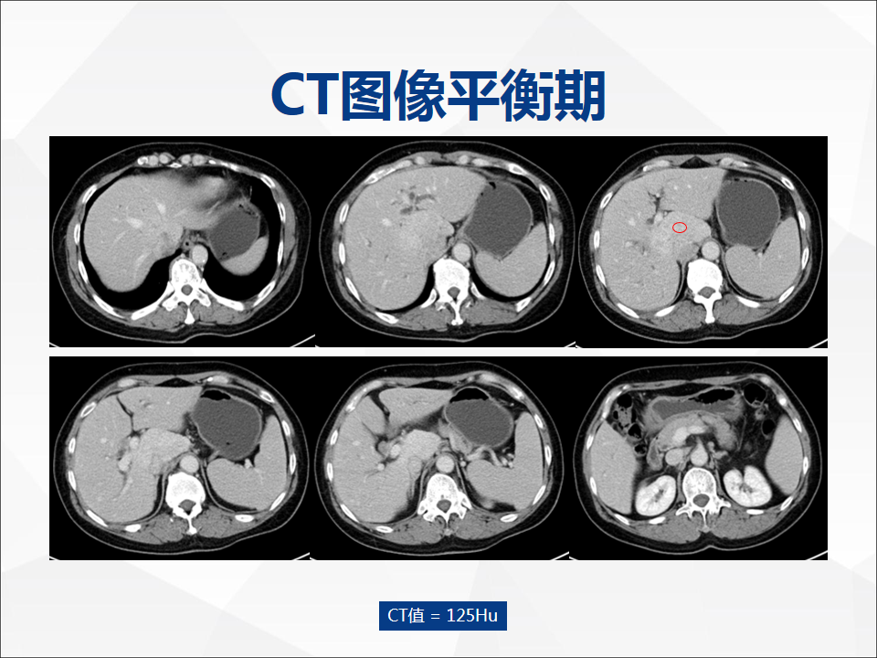 影像PPT - 【病例】肝脏胆管细胞癌1例CT及MR影像-5