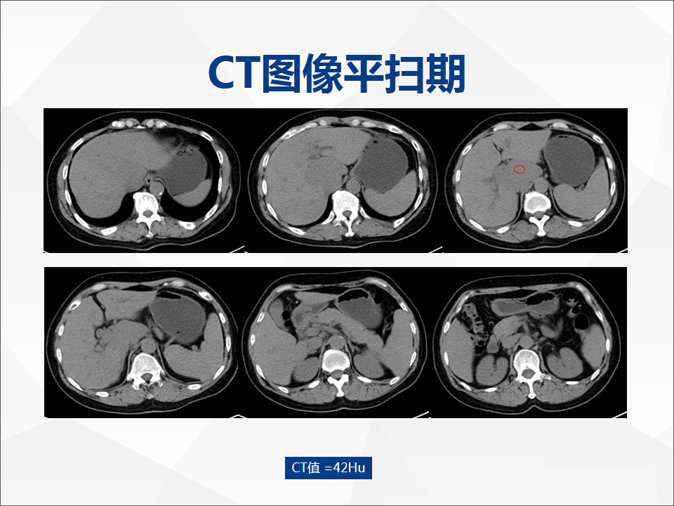 影像PPT - 【病例】肝脏胆管细胞癌1例CT及MR影像-3