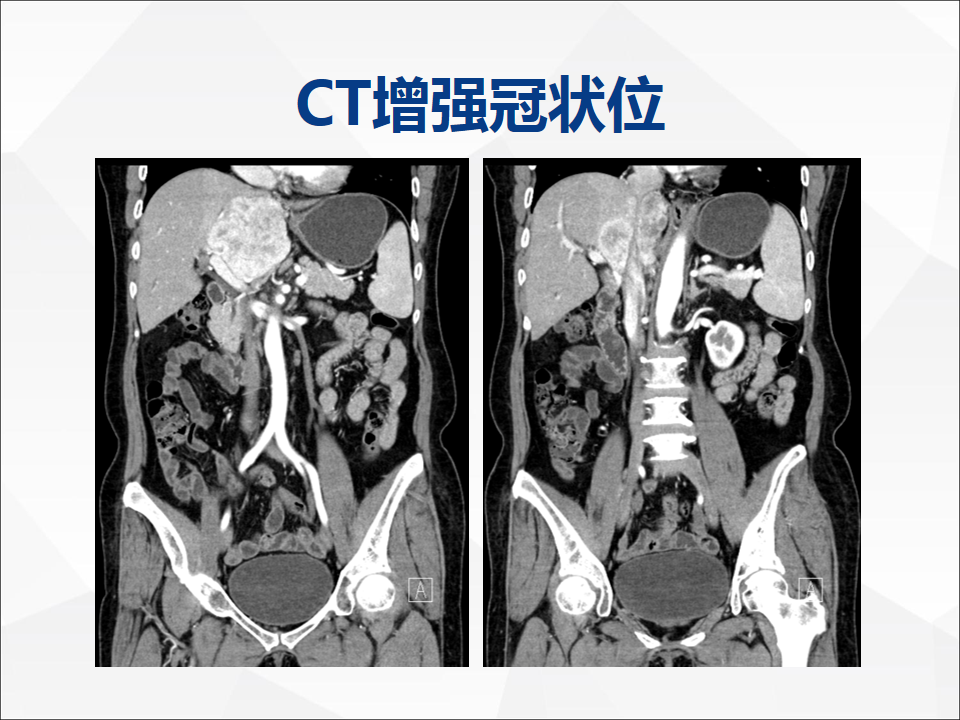 影像PPT - 【病例】肝脏胆管细胞癌1例CT及MR影像-6