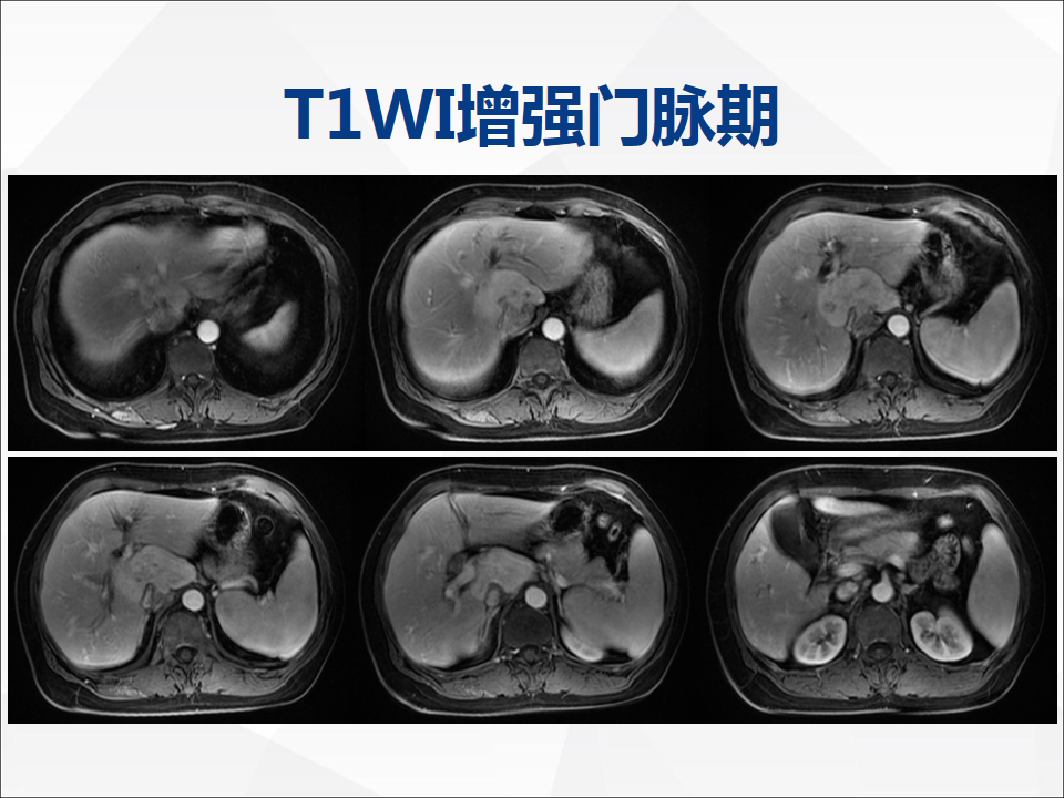 影像PPT - 【病例】肝脏胆管细胞癌1例CT及MR影像-12