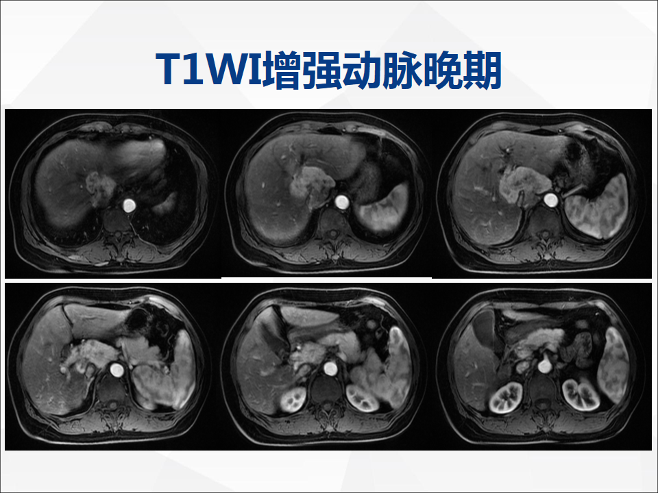 影像PPT - 【病例】肝脏胆管细胞癌1例CT及MR影像-11